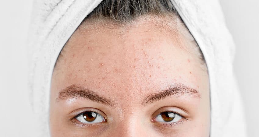 consejos para evitar acne